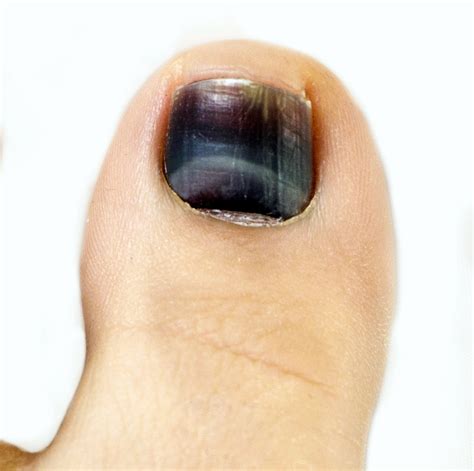 stubbed toe nail turned black